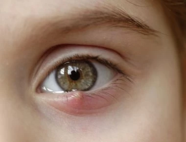 Είναι κριθαράκι ή χαλάζιο; Σε τι διαφέρουν – Αίτια, συμπτώματα, θεραπεία και πρόληψη